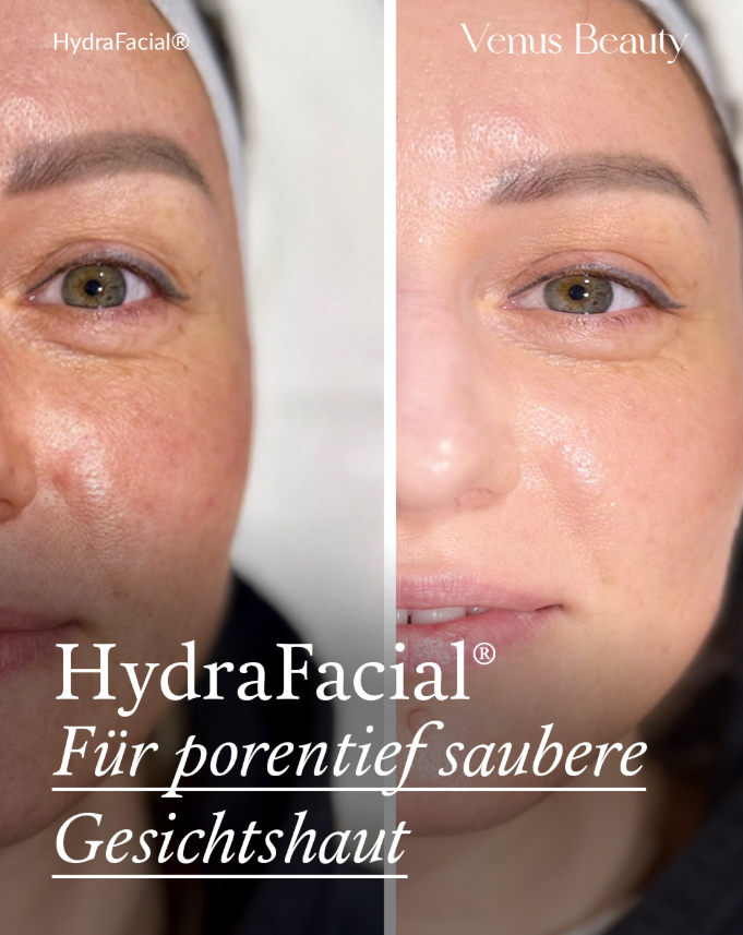 hydrafacial für porentiefe reinheit